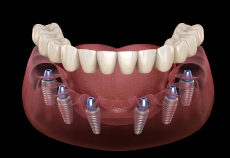 20221208_implant-toan-ham-4