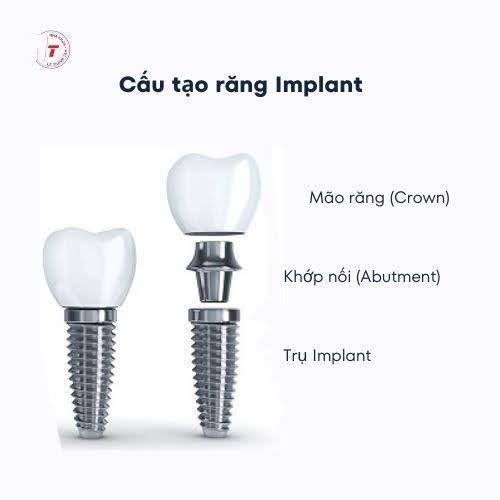 Cấy Ghép Implant 2