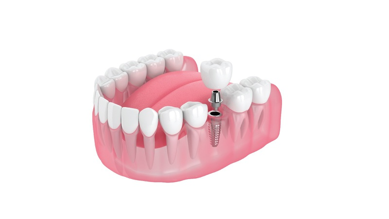 Cấy Ghép Implant