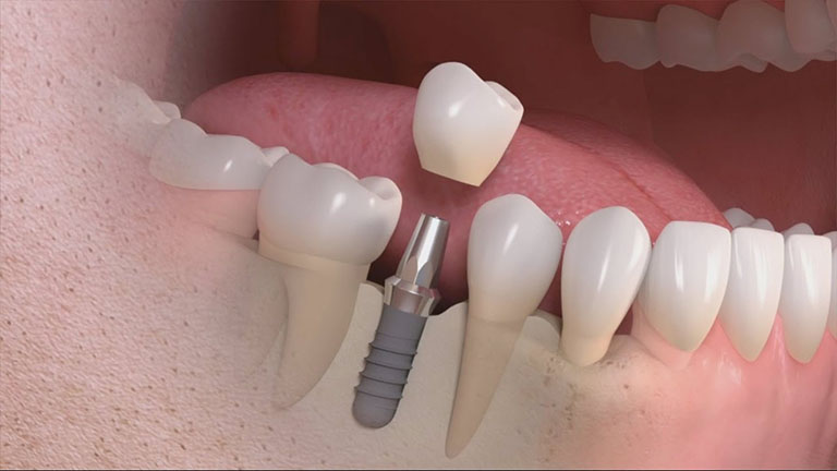 implant