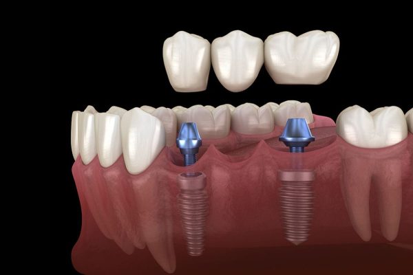 Phuc-hinh-rang-su-tren-implant-600x400