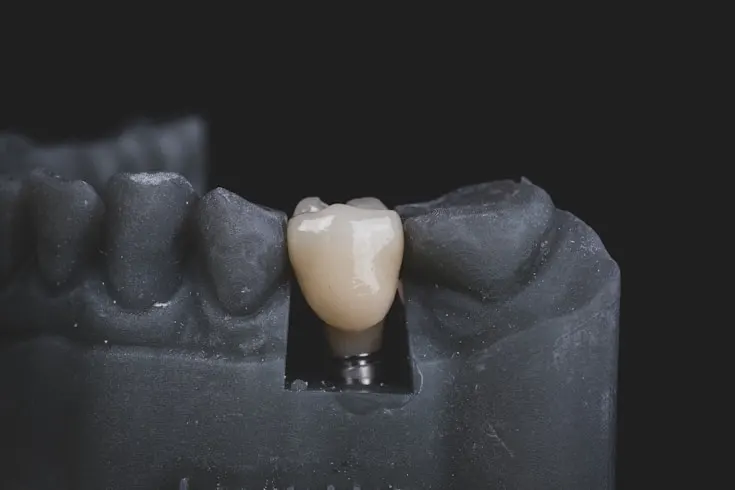 Cấy Ghép Implant
