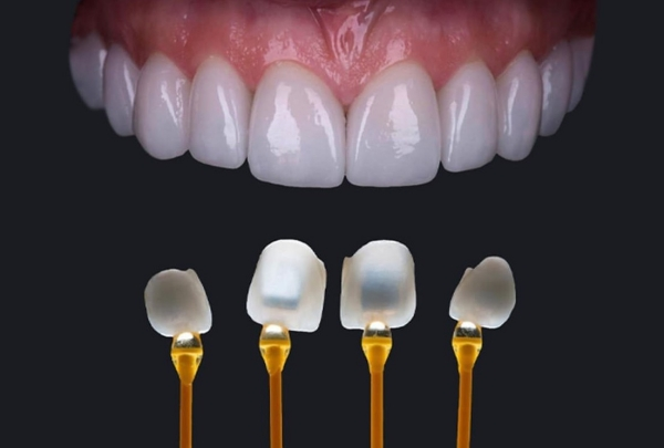 Dán Sứ Veneer